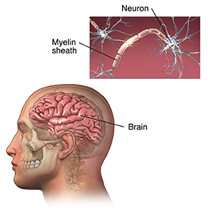 Multiple Sclerosis (MS) | Cedars-Sinai